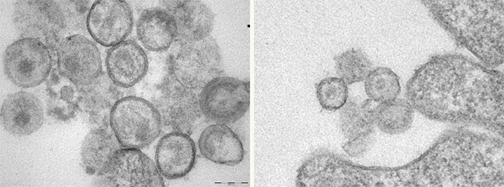 Cells without the Human Schlafen 11 gene have more HIV virus-like particles (seen as round dots at left) than cells at right that express the gene. 