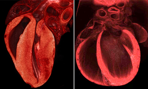 Heart with thick ventricle walls and normal heart