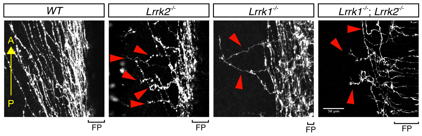 A set of neuronal images show missing spinal cord axons in cases missing LRRK genes versus normal growth of cases with LRRK genes.