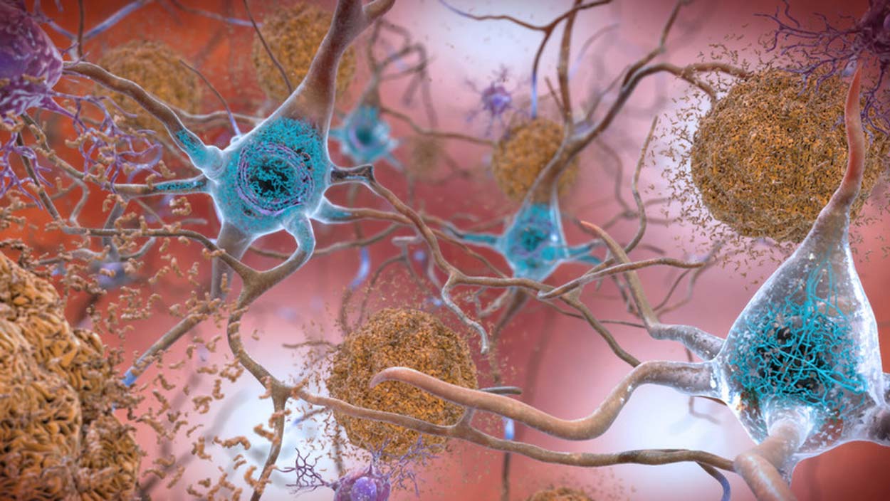 Amyloid plaques and tau tangles in the brain accumulate which then leads to neural degeneration